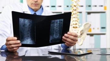 Common Questions about Spinal Cord Injuries