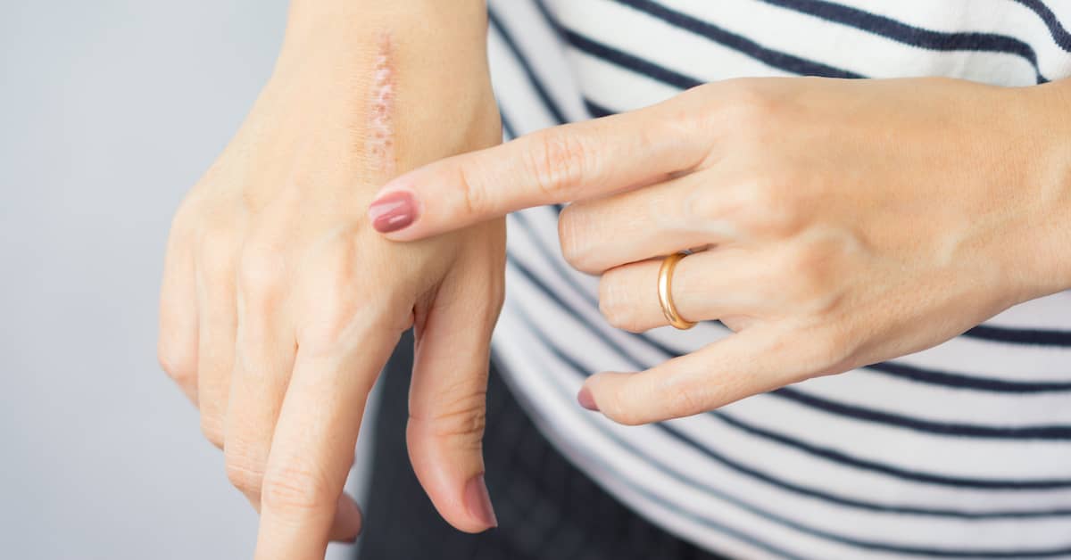 woman applying ointment to a burn injury scar on her hand