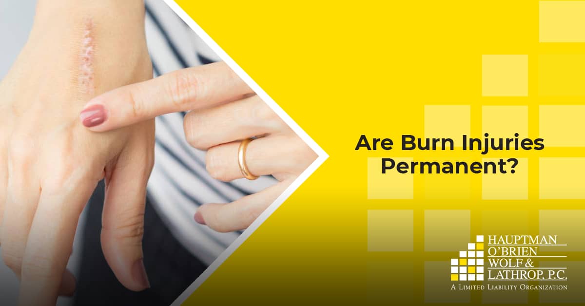 Do Burns Ever Fully Heal? Hauptman O'Brien Wolf & Lathrop